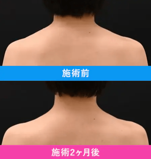 湘南　肩ボトックス　症例